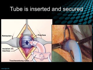 Tube is inserted and secured
 