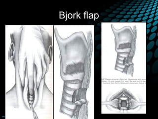 Bjork flap
 