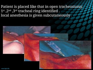 Patient is placed like that in open tracheostomy.
1st
,2nd
,3rd
tracheal ring identified .
local anesthesia is given subcutaneously .
 