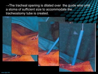 →The tracheal opening is dilated over the guide wire until
a stoma of sufficient size to accommodate the
tracheostomy tube is created.
 