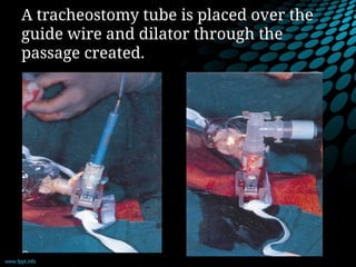 A tracheostomy tube is placed over the
guide wire and dilator through the
passage created.
 