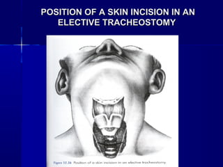 POSITION OF A SKIN INCISION IN ANPOSITION OF A SKIN INCISION IN AN
ELECTIVE TRACHEOSTOMYELECTIVE TRACHEOSTOMY
 