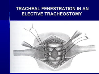 TRACHEAL FENESTRATION IN ANTRACHEAL FENESTRATION IN AN
ELECTIVE TRACHEOSTOMYELECTIVE TRACHEOSTOMY
 