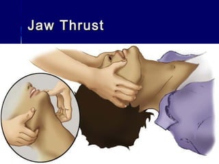 Jaw ThrustJaw Thrust
 