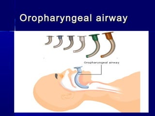 Oropharyngeal airwayOropharyngeal airway
 
