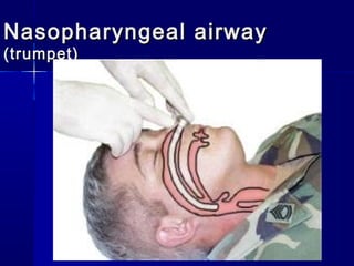 Nasopharyngeal airwayNasopharyngeal airway
(trumpet)(trumpet)
 