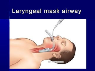 Laryngeal mask airwayLaryngeal mask airway
 
