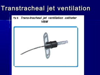 Transtracheal jet ventilationTranstracheal jet ventilation
 