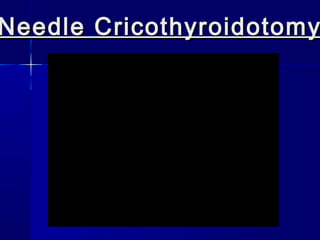 Needle CricothyroidotomyNeedle Cricothyroidotomy
 