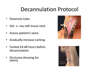 Tracheostomy | PPTX