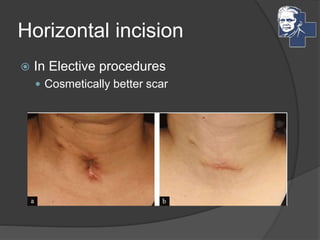 Horizontal incision
 In Elective procedures
 Cosmetically better scar
 