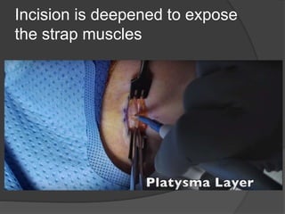 Incision is deepened to expose
the strap muscles
 