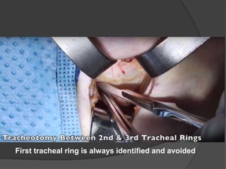 First tracheal ring is always identified and avoided
 