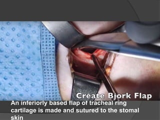 An inferiorly based flap of tracheal ring
cartilage is made and sutured to the stomal
skin
 