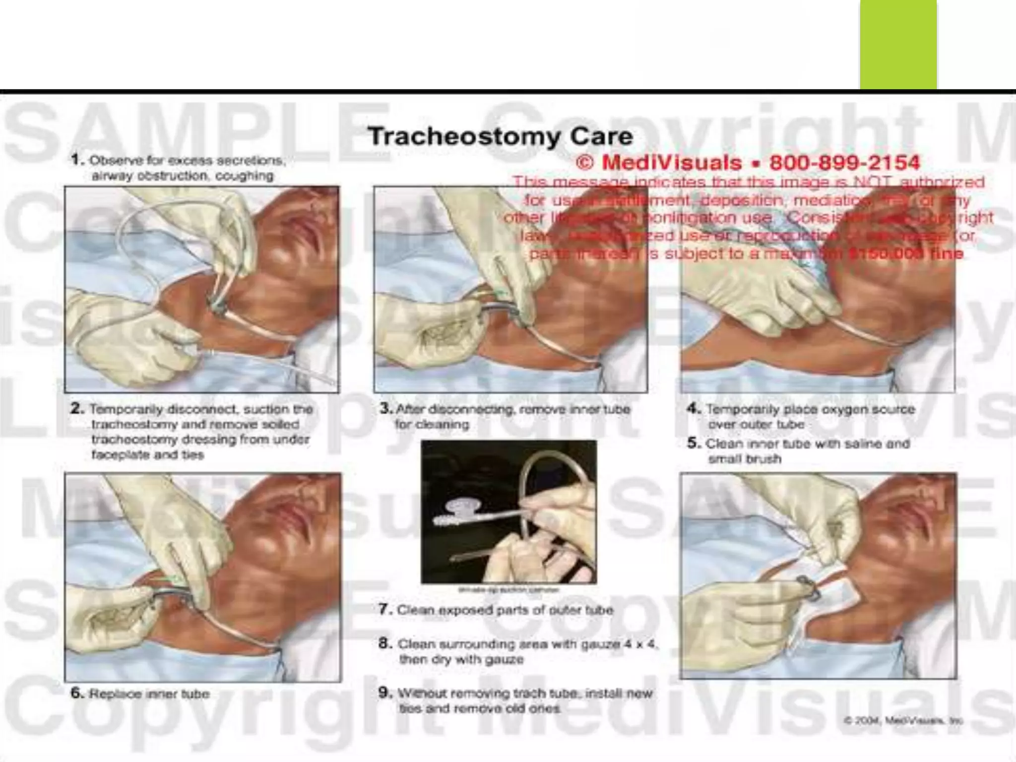 Tracheostomy | PPTX