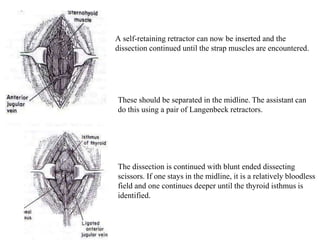 A self-retaining retractor can now be inserted and the
dissection continued until the strap muscles are encountered.
These should be separated in the midline. The assistant can
do this using a pair of Langenbeck retractors.
The dissection is continued with blunt ended dissecting
scissors. If one stays in the midline, it is a relatively bloodless
field and one continues deeper until the thyroid isthmus is
identified.
 