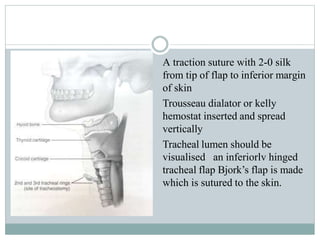 ⚫ A traction suture with 2-0 silk
from tip of flap to inferior margin
of skin
⚫
⚫
Trousseau dialator or kelly
hemostat inserted and spread
vertically
Tracheal lumen should be
visualised an inferiorlv hinged
tracheal flap Bjork’s flap is made
which is sutured to the skin.
 