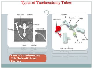 Types of Tracheostomy Tubes
Parts of a Tracheostomy
Tube Tube with inner
Cannula
 