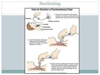 Suctioning
 