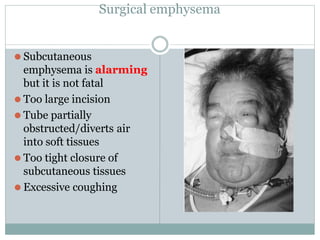 Surgical emphysema
⚫ Subcutaneous
emphysema is alarming
but it is not fatal
⚫ Too large incision
⚫ Tube partially
obstructed/diverts air
into soft tissues
⚫ Too tight closure of
subcutaneous tissues
⚫ Excessive coughing
 