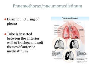 Pnuemothorax/pneumomedistinum
⚫Direct puncturing of
pleura
⚫Tube is inserted
between the anterior
wall of trachea and soft
tissues of anterior
mediastinum
 