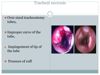 Tracheal necrosis
⚫ Over sized tracheostomy
tubes,
⚫ Improper curve of the
tube,
⚫ Impingement of tip of
the tube
⚫ Pressure of cuff
 