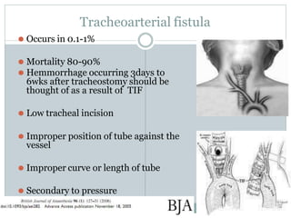 Tracheoarterial fistula
⚫ Occurs in 0.1-1%
⚫ Mortality 80-90%
⚫ Hemmorrhage occurring 3days to
6wks after tracheostomy should be
thought of as a result of TIF
⚫ Low tracheal incision
⚫ Improper position of tube against the
vessel
⚫ Improper curve or length of tube
⚫ Secondary to pressure
 