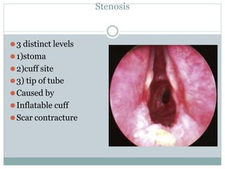 Stenosis
⚫3 distinct levels
⚫1)stoma
⚫2)cuff site
⚫3) tip of tube
⚫Caused by
⚫Inflatable cuff
⚫Scar contracture
 