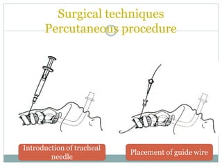 Surgical techniques
Percutaneous procedure
Introduction of tracheal
needle
Placement of guide wire
 