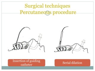 Surgical techniques
Percutaneous procedure
Insertion of guiding
catheter
Serial dilation
 