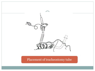 Placement of tracheostomy tube
 