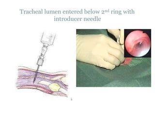 Tracheal lumen entered below 2nd ring with
introducer needle
 