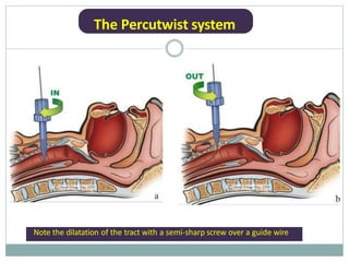 The Percutwist system
Note the dilatation of the tract with a semi-sharp screw over a guide wire
 