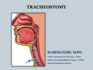 TRACHEOSTOMY
Dr.HIMANSHU SONI
Fellow in Head and Neck Oncology - FHNO
Fellow in Craniomaxillofacial Trauma – AOMSI
Oral and Maxillofacial Surgeon
 