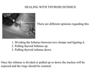 DEALING WITH THYROID ISTHMUS
There are different opinions regarding this
1. Dividing the Isthmus between two clamps and ligating it.
2. Pulling thyroid Isthmus up.
3. Pulling thyroid isthmus down.
Once the isthmus is divided or pulled up or down the trachea will be
exposed and the rings should be counted.
 
