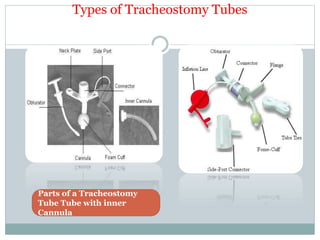 Types of Tracheostomy Tubes
Parts of a Tracheostomy
Tube Tube with inner
Cannula
 