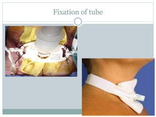 Fixation of tube
 