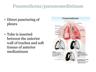 Pnuemothorax/pneumomedistinum
 Direct puncturing of
pleura
 Tube is inserted
between the anterior
wall of trachea and soft
tissues of anterior
mediastinum
 