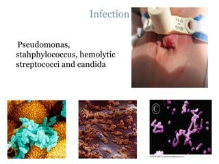 Infection
Pseudomonas,
stahphylococcus, hemolytic
streptococci and candida
 