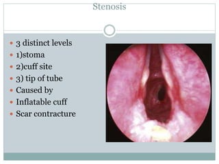 Stenosis
 3 distinct levels
 1)stoma
 2)cuff site
 3) tip of tube
 Caused by
 Inflatable cuff
 Scar contracture
 