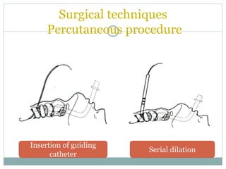 Surgical techniques
Percutaneous procedure
Insertion of guiding
catheter
Serial dilation
 