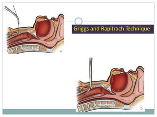 Griggs and Rapitrach Technique
 