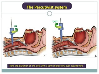 The Percutwist system
Note the dilatation of the tract with a semi-sharp screw over a guide wire
 