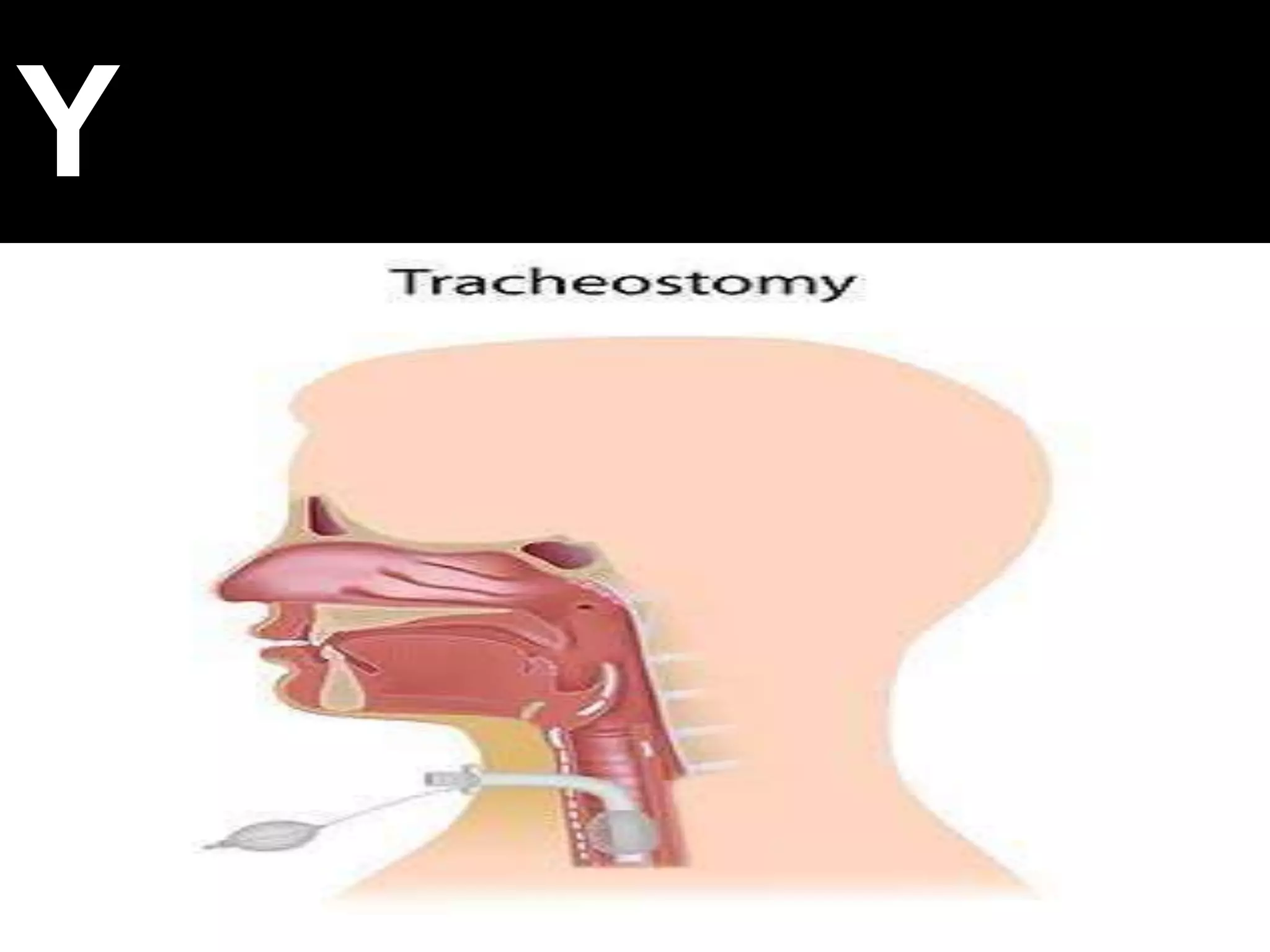 Tracheostomy ( for medical students ) | PPTX