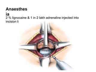 Anaesthes
ia
2 % lignocaine & 1 in 2 lakh adrenaline injected into
incision line
 