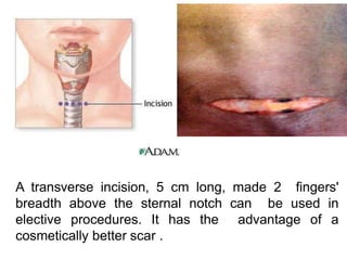 A transverse incision, 5 cm long, made 2 fingers'
breadth above the sternal notch can be used in
elective procedures. It has the advantage of a
cosmetically better scar .
 