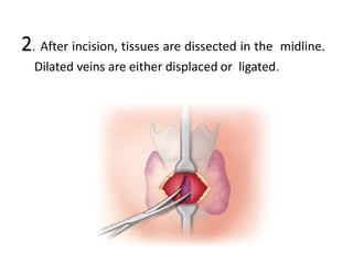 2. After incision, tissues are dissected in the midline.
Dilated veins are either displaced or ligated.
 