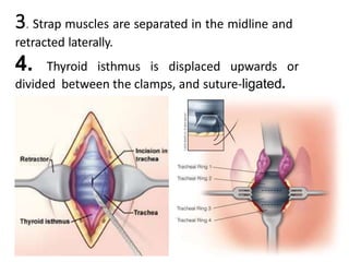 3. Strap muscles are separated in the midline and
retracted laterally.
4. Thyroid isthmus is displaced upwards or
divided between the clamps, and suture-ligated.
 