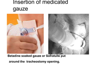 Insertion of medicated
gauze
Betadine soaked gauze or Sofratulle put
around the tracheostomy opening.
 