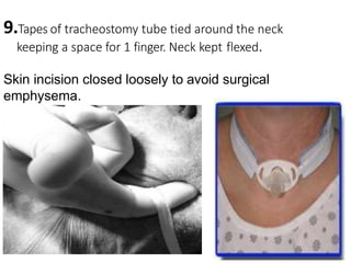 9.Tapes of tracheostomy tube tied around the neck
keeping a space for 1 finger. Neck kept flexed.
Skin incision closed loosely to avoid surgical
emphysema.
 